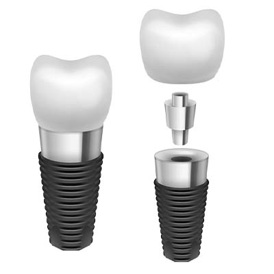 Best Dental implants in Abu Dhabi