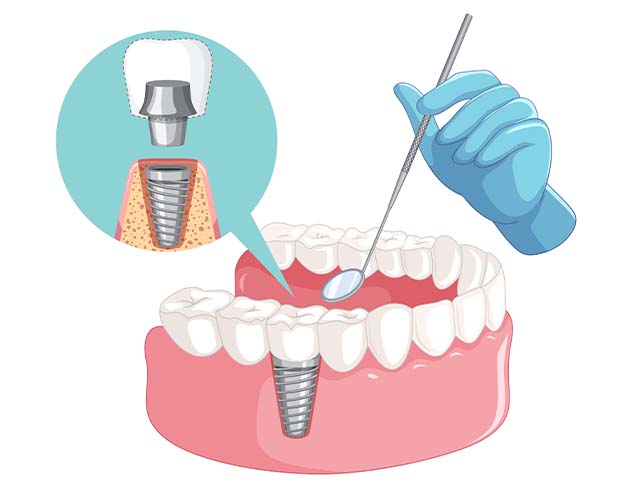 Dental implants in Abu Dhabi