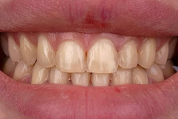 Hollywood_Before_puremed